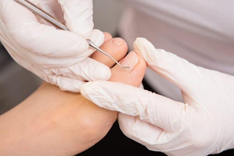 Gloved nurse using a nail hook tool for precise diabetic nail care